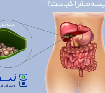 سنگ کیسه صفرا