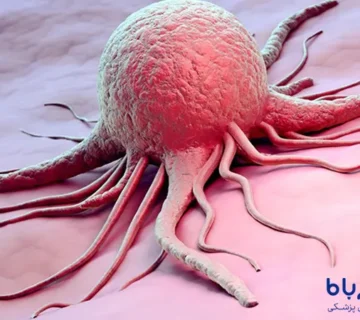 بیماریسرطان