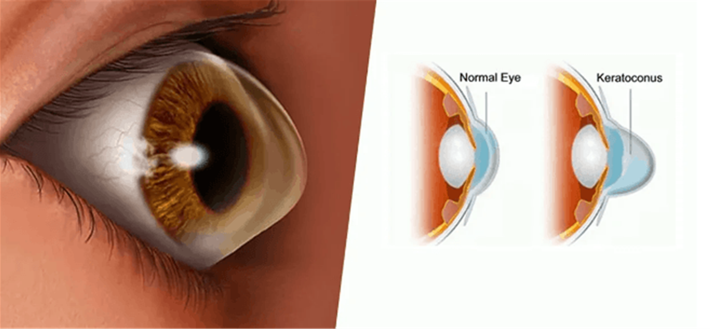 روشهای درمان قوز قرنیه